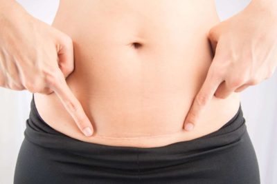 Post C-Section Scar Healing & Treatment