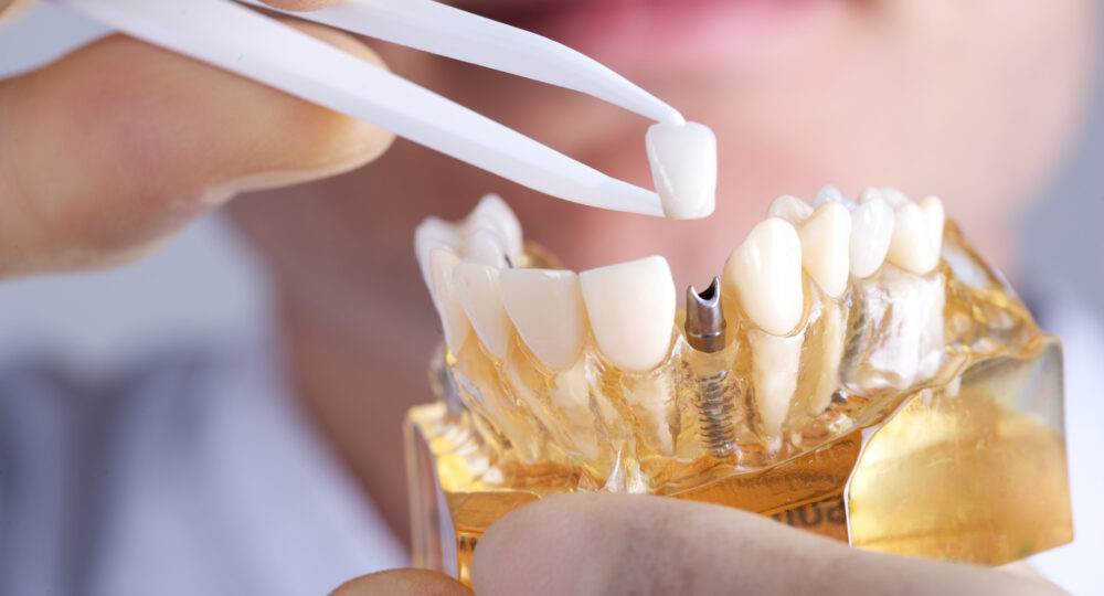 How Dental Implants Can Significantly Improve Your Quality of Life