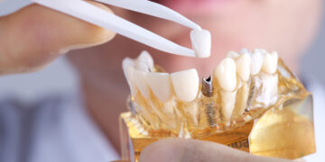 How Dental Implants Can Significantly Improve Your Quality of Life