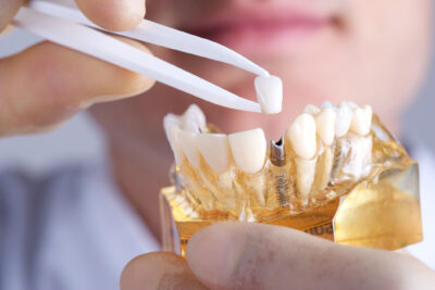 How Dental Implants Can Significantly Improve Your Quality of Life