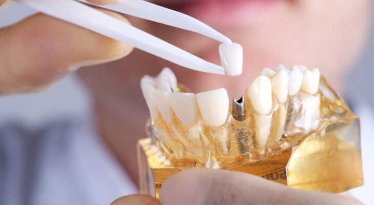 How Dental Implants Can Significantly Improve Your Quality of Life